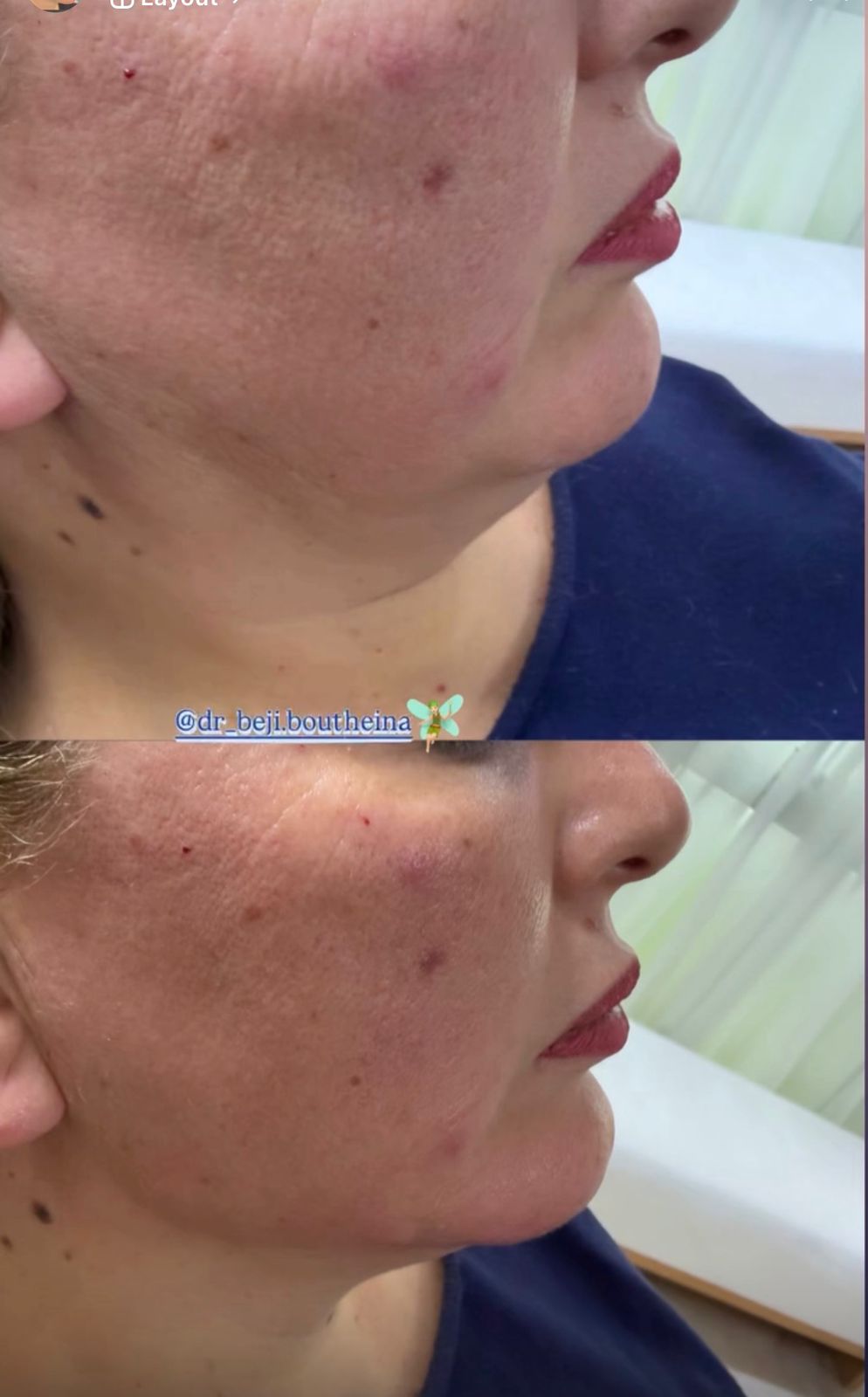 Non-Surgical Lifting